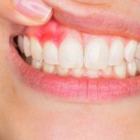 Gingivitis-gevoelig-tandvlees_0 Gingivitis-gevoelig-tandvlees_0